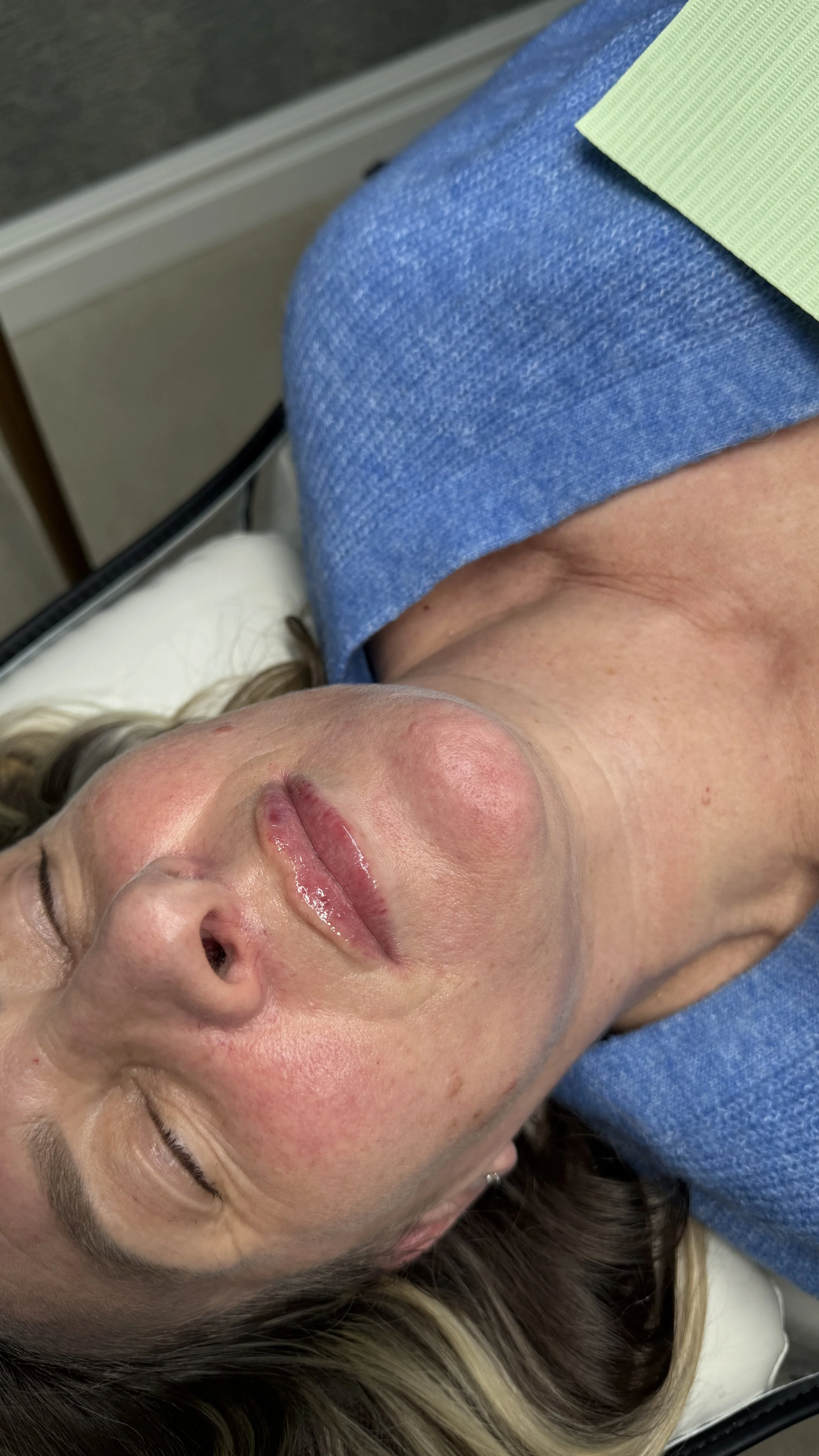 A woman lying on a medical bed with her eyes closed, lips slightly moist, and a red mark on her cheek, wearing a blue and green hospital gown.