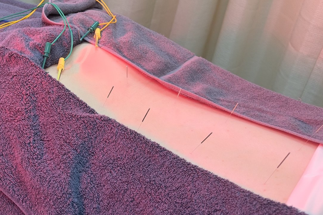 宇都宮市桜の美容鍼・鍼専門　えん鍼灸院　腰痛・肩こり施術イメージ画像