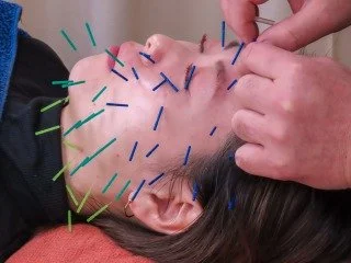 宇都宮市 えん鍼灸院の美容鍼施術の様子
