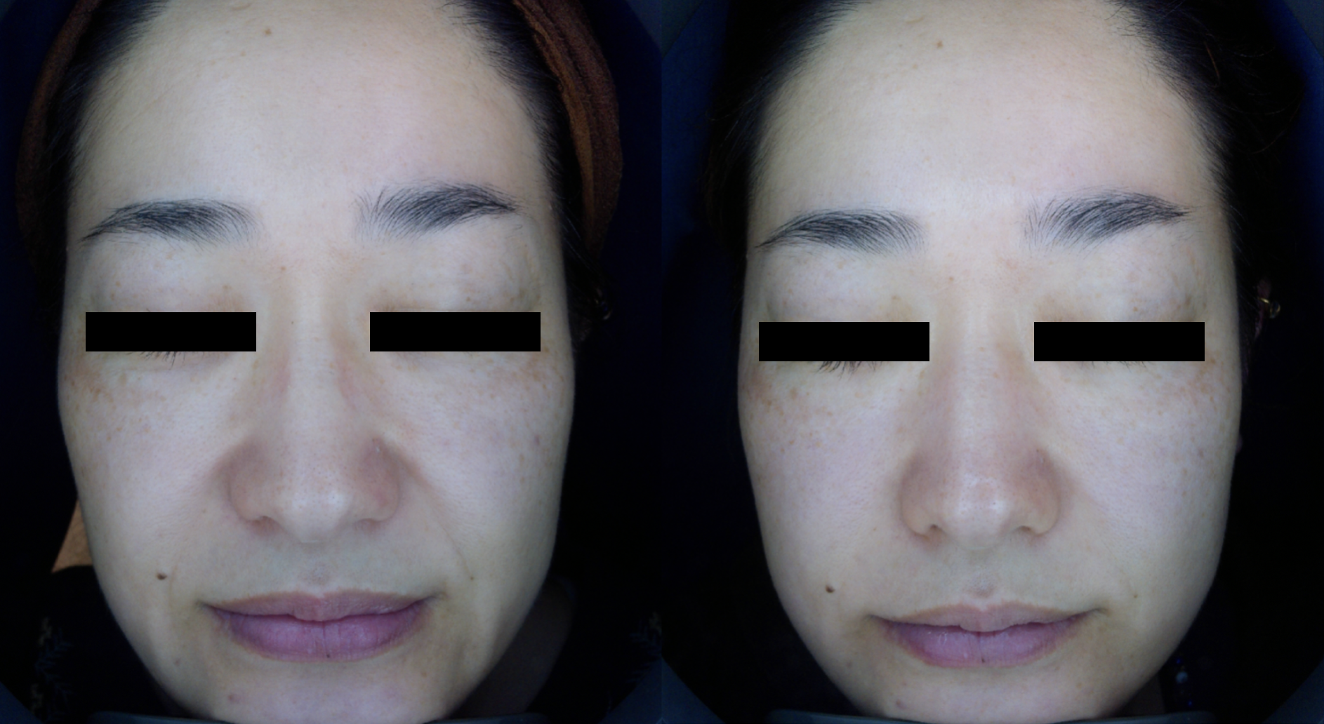 宇都宮市桜の美容鍼・鍼専門　えん鍼灸院の美容鍼ビフォーアフター