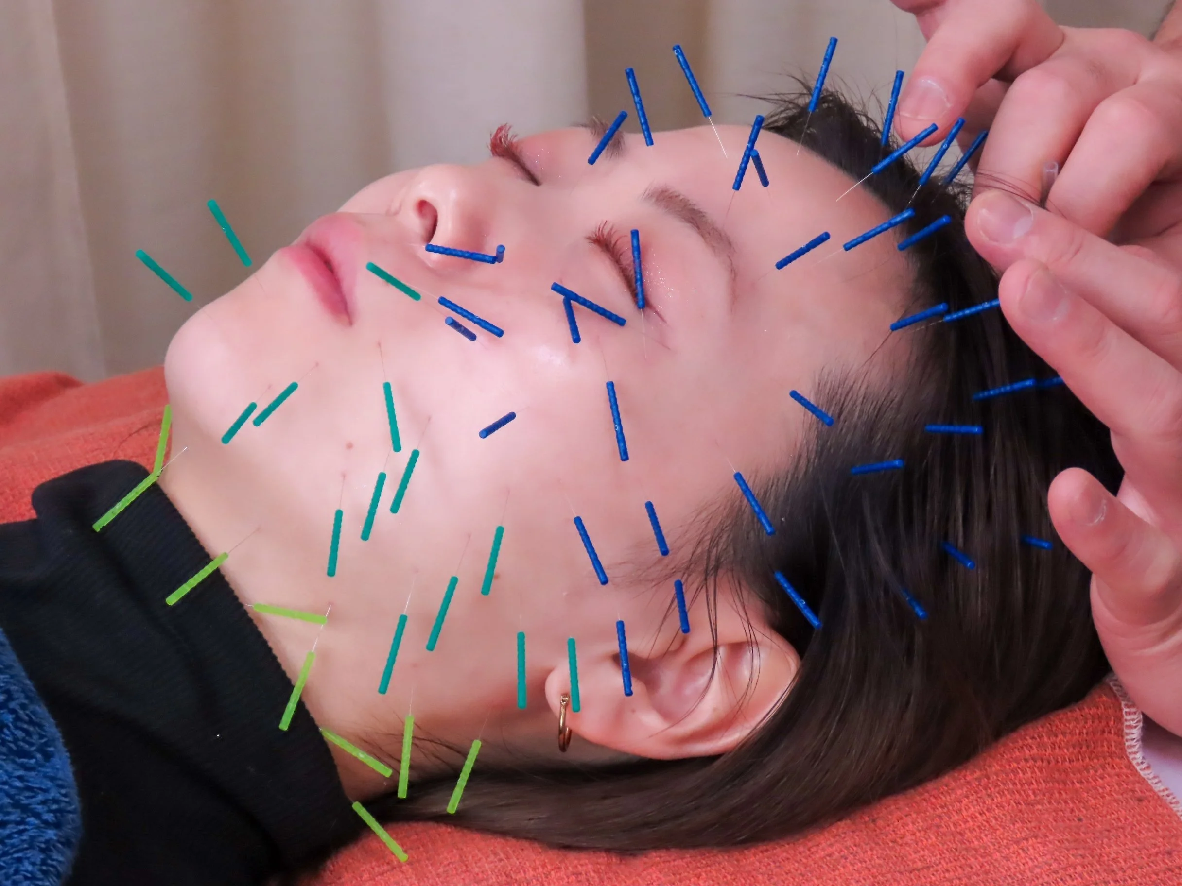 宇都宮市の美容鍼専門 えん鍼灸院の美容鍼施術