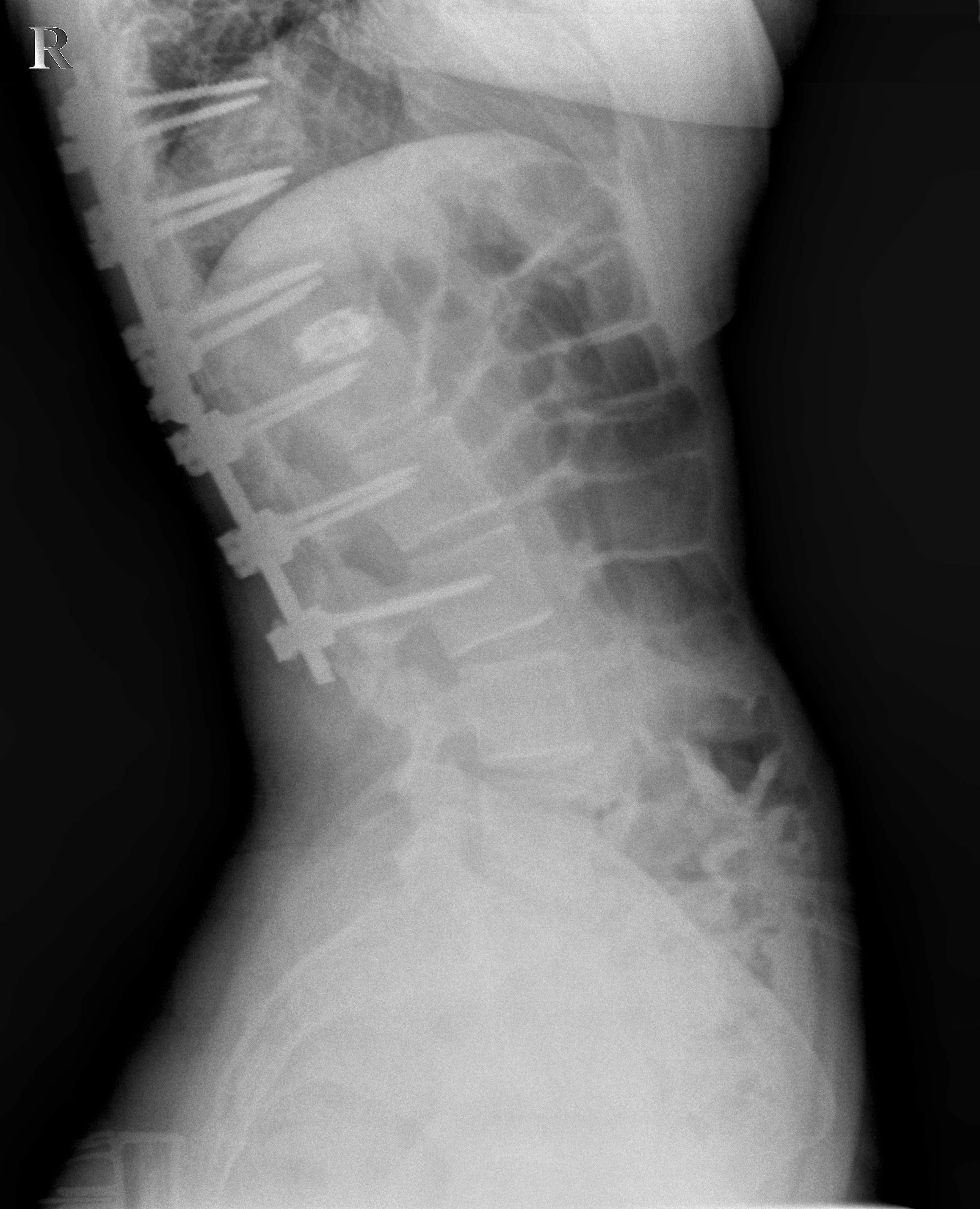 Chiropractic Care &amp; Spinal Fusions: A Patient Case