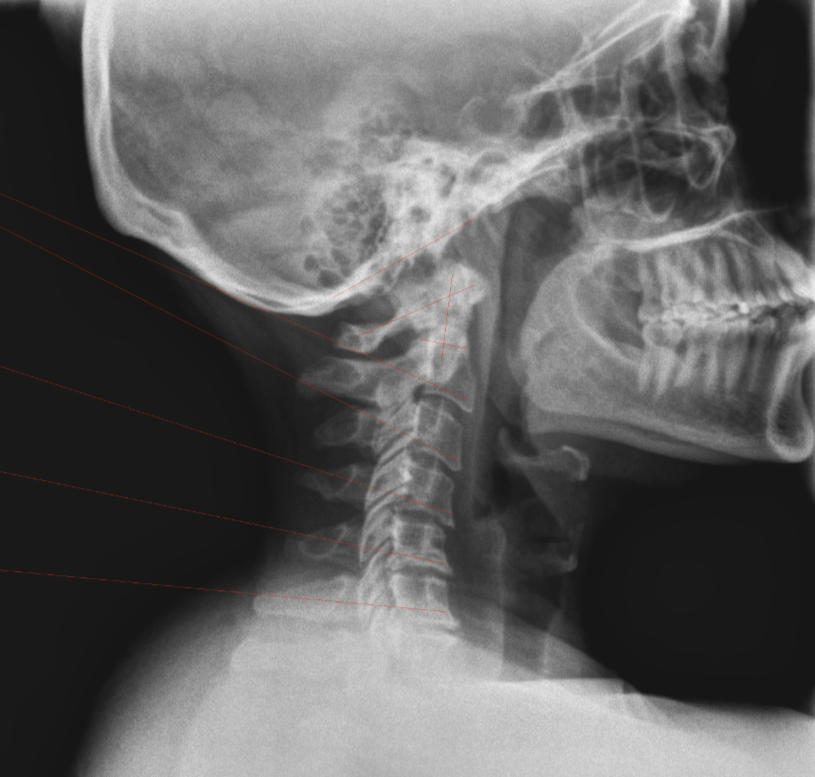 Restoring Spinal Structure &amp; Function After Whiplash Injury