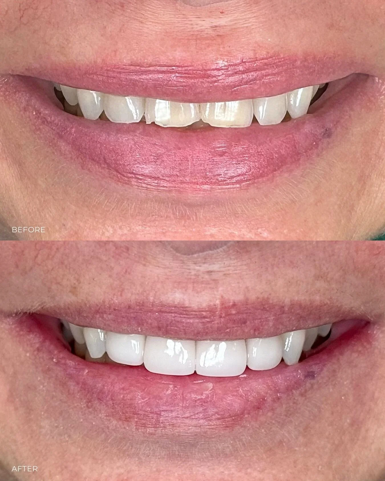 We love a good smile makeover! Check out this transformation -&gt; 4 porcelain crowns &amp; our patient looks years younger - proof that a confident smile is the best glow-up ✨🦷