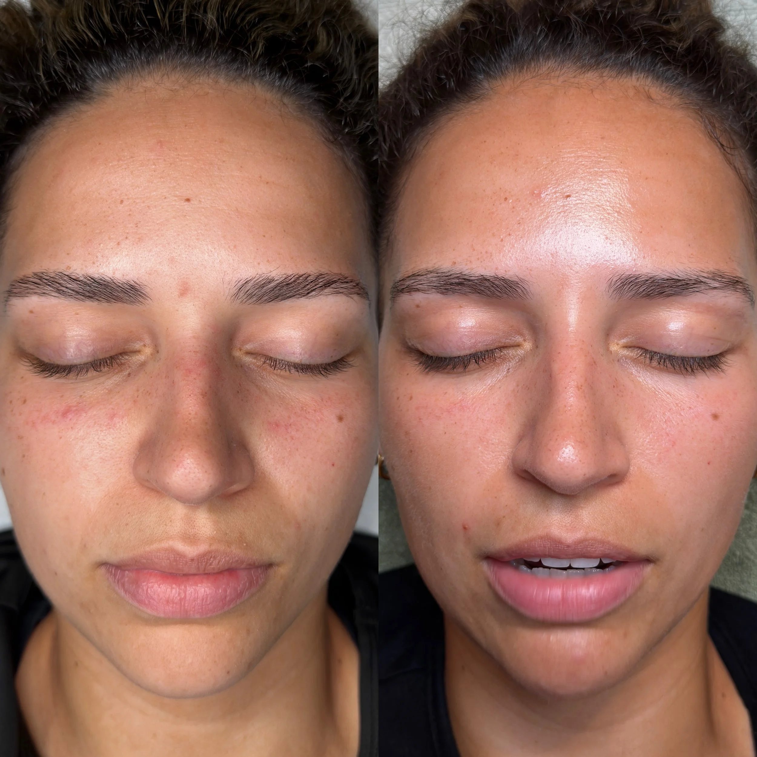 8 weeks - NO treatment - 3 products 

Redness, random breakouts and dryness. This is what was happening although the diet was clean, the sleep was on point and the stress was minimal. 

Sound familiar? My client just needed some direction with produc