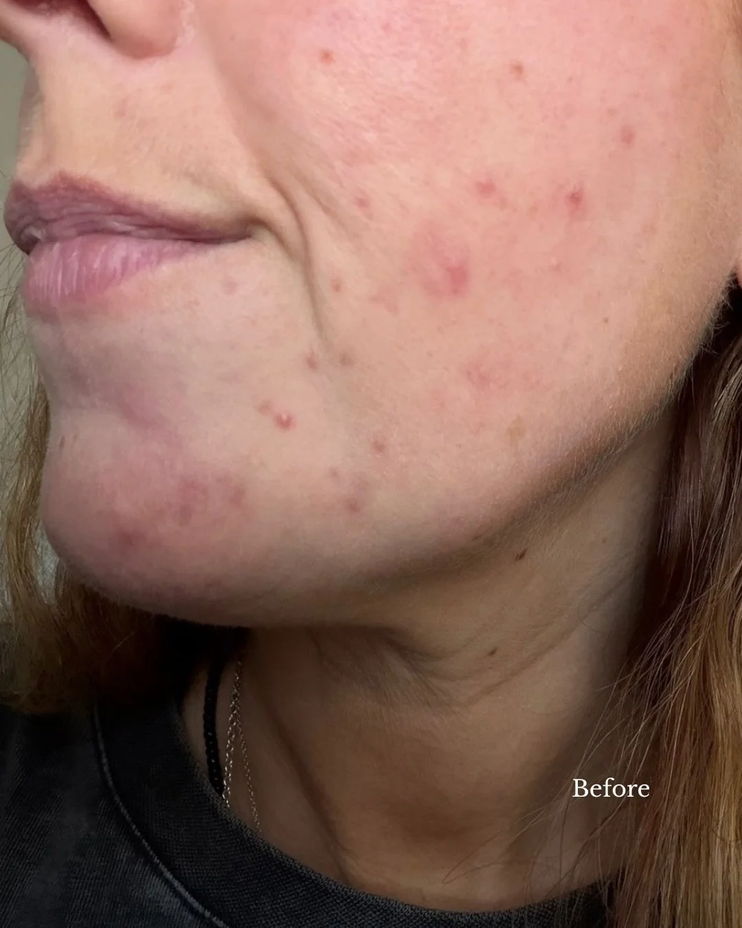 Imagine going to your GP about something completely unrelated to your skin&hellip;

Being put on medication.
That medication triggering acne.
Then being given more tablets, more creams, even steroids, to fix the acne the first lot caused.

And every 