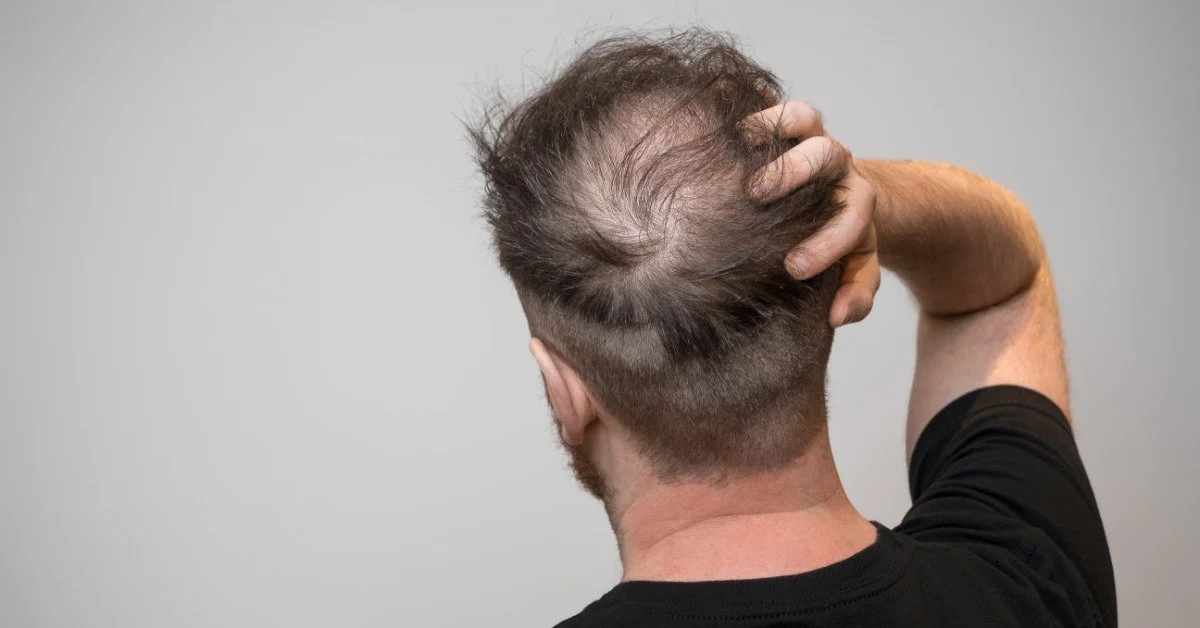 A closeup on the back of the head of a young man. He is visibly balding at the crown of his head, exposing his scalp.