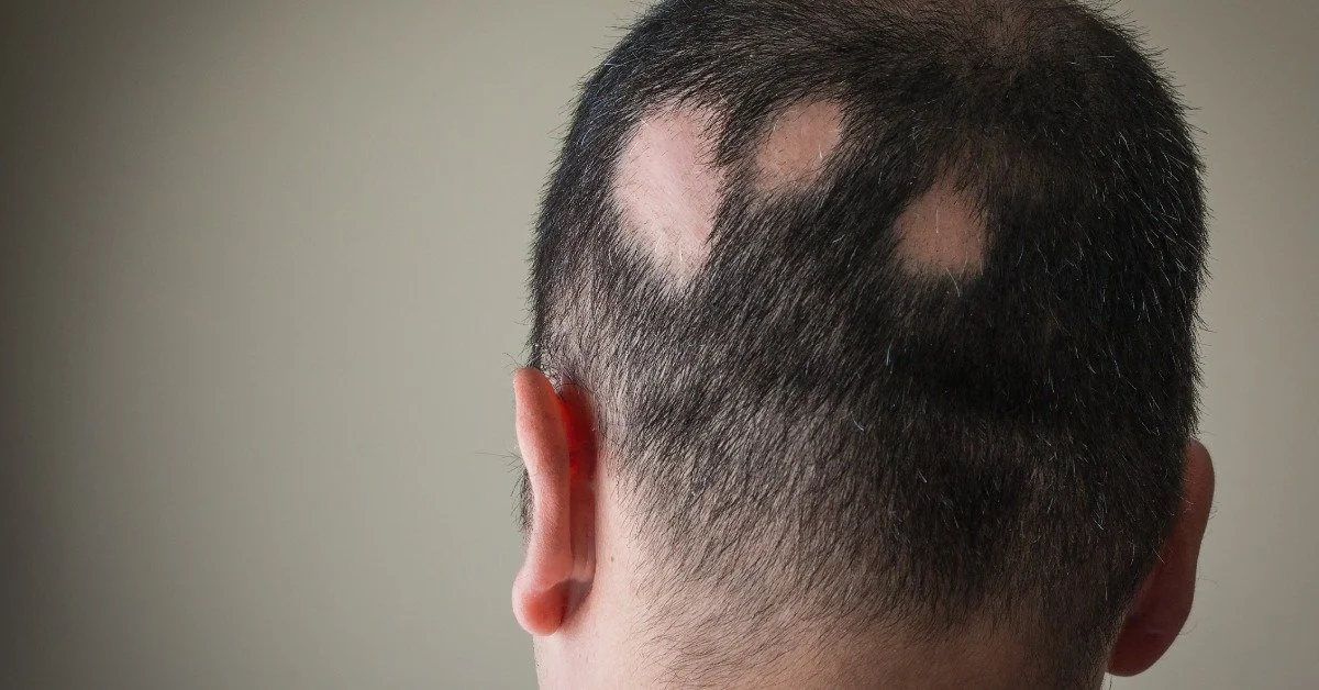 The back of a man's head. He has three bald spots on the side of his head that are the result of alopecia.
