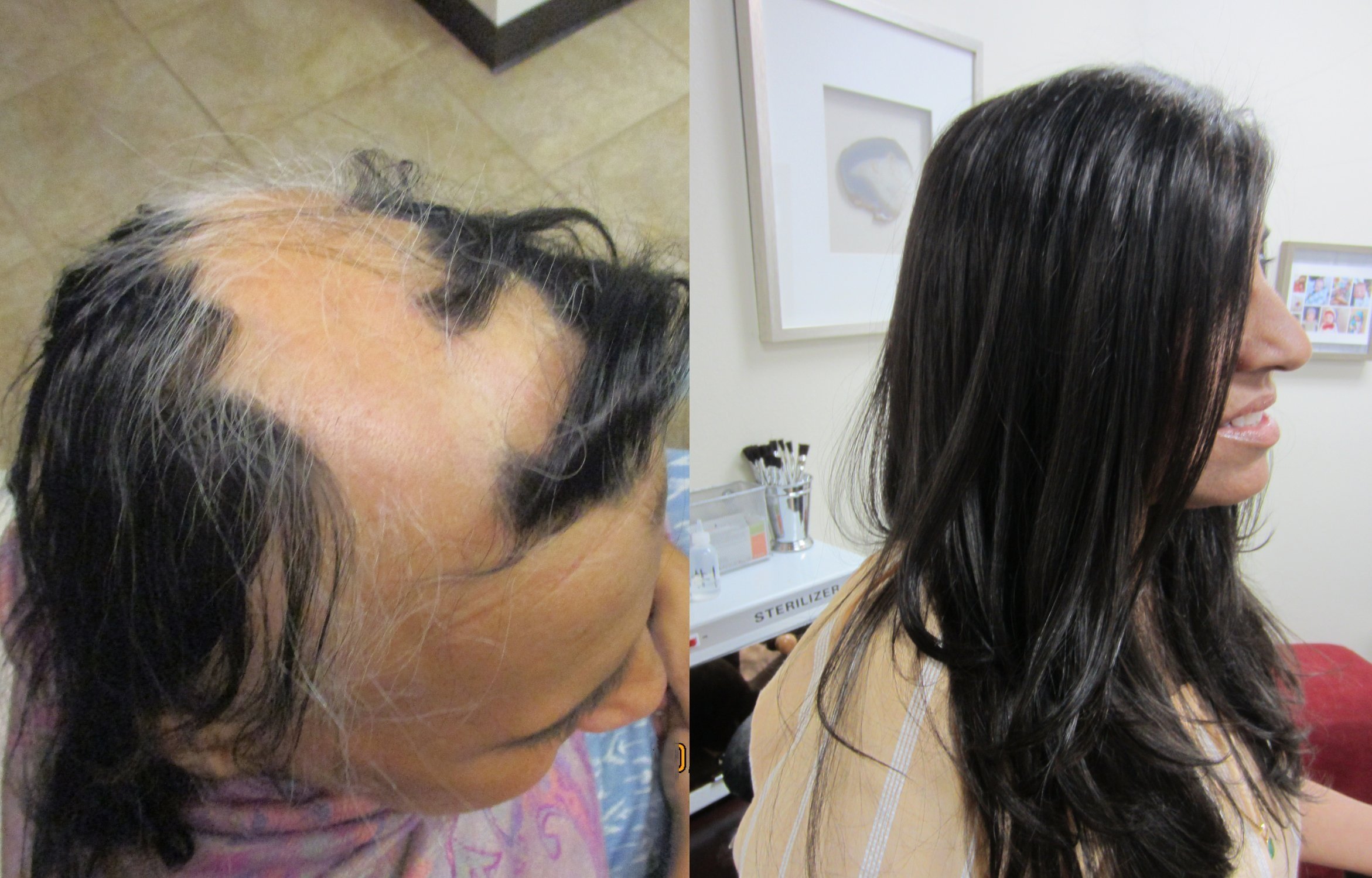 Before and after hair replacement