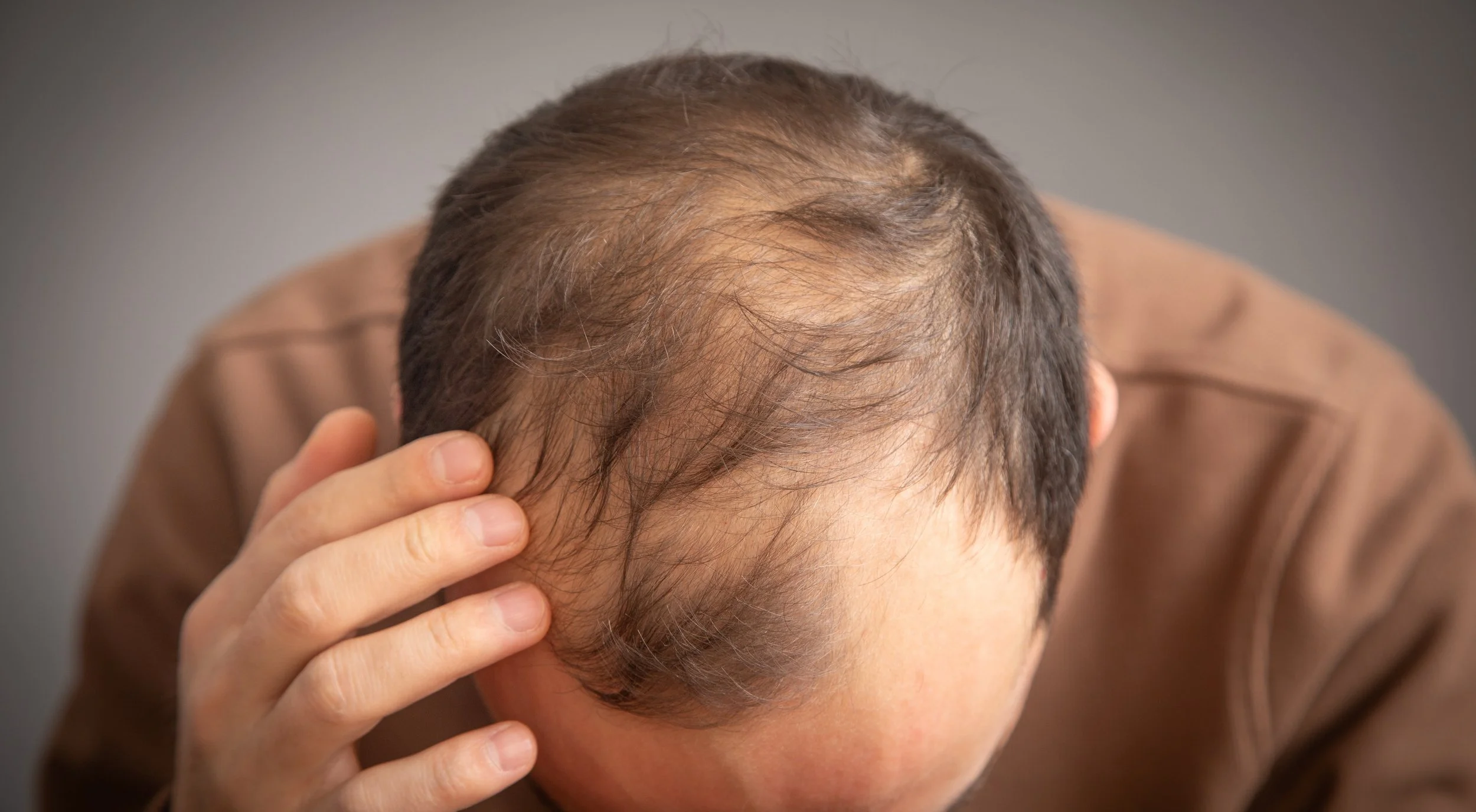 Is Hair Replacement Right for You?