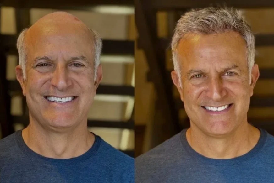 Custom Hair Systems for Men with Grey Hair: The 2026 Guide to Natural Restoration