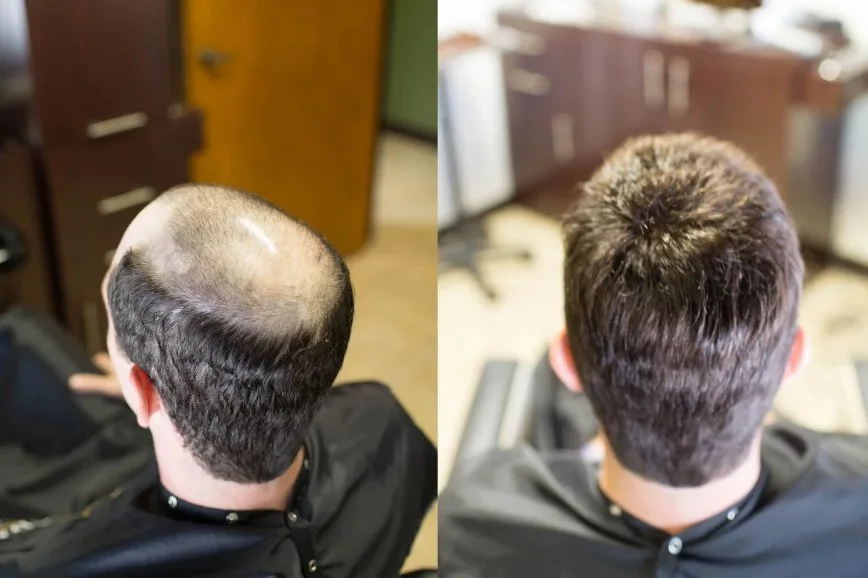 California Hair Loss: Non-Surgical Options in Calabasas