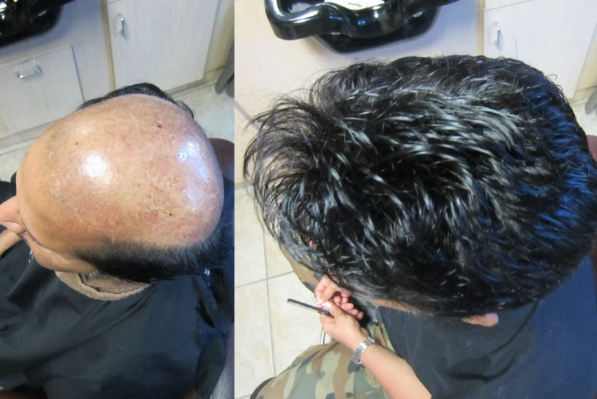 Understanding the Norwood Scale: A Clear, Thursday’s Hair Solutions- Friendly Guide to Male Pattern Hair Loss
