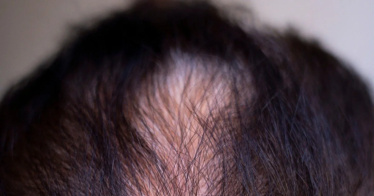 A top-down view of a man's head. There is a strip of exposed skin in the center of his head where he has gone bald.