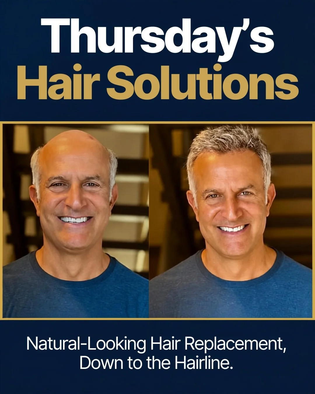 A natural-looking hairline can make all the difference.

When it comes to hair replacement, the details matter. A thoughtfully designed hairline, customized to your features and natural hair, helps create a result that looks and feels like you.

At T