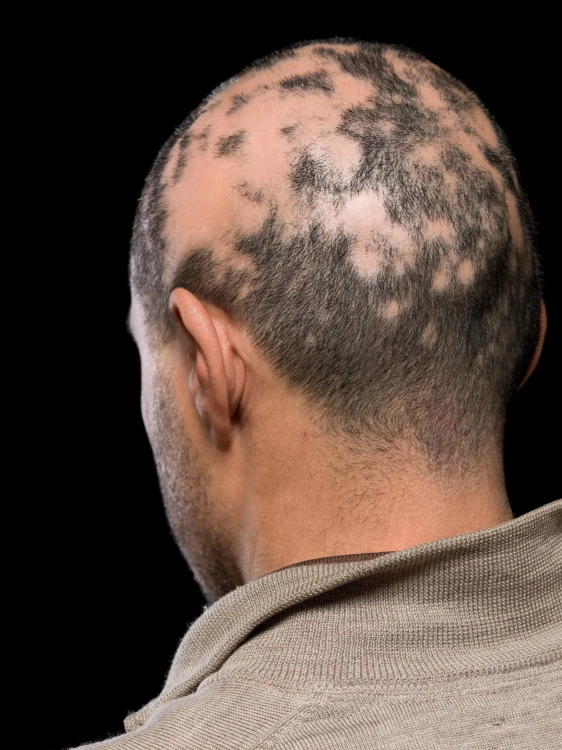 Illness & Hormonal Hair Loss — Thursday's Hair Solutions