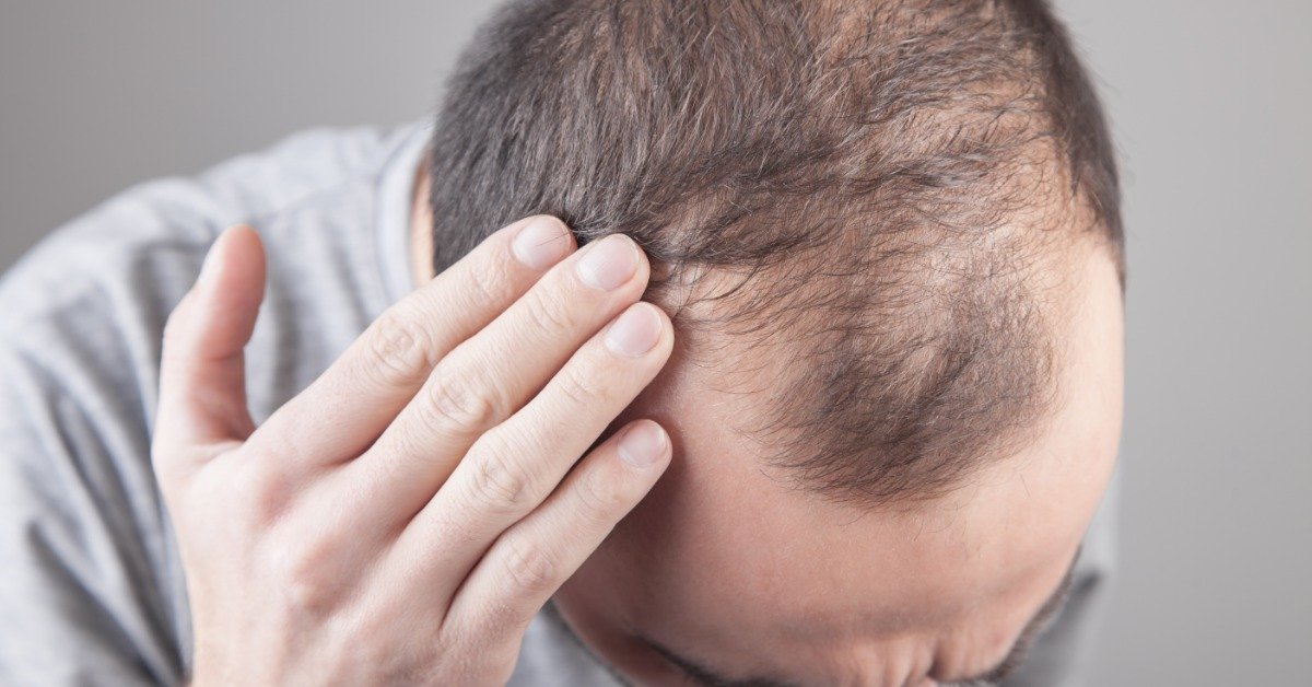 A man who is visibly balding putting one hand up to his hair line as he inspects the amount of hair loss.