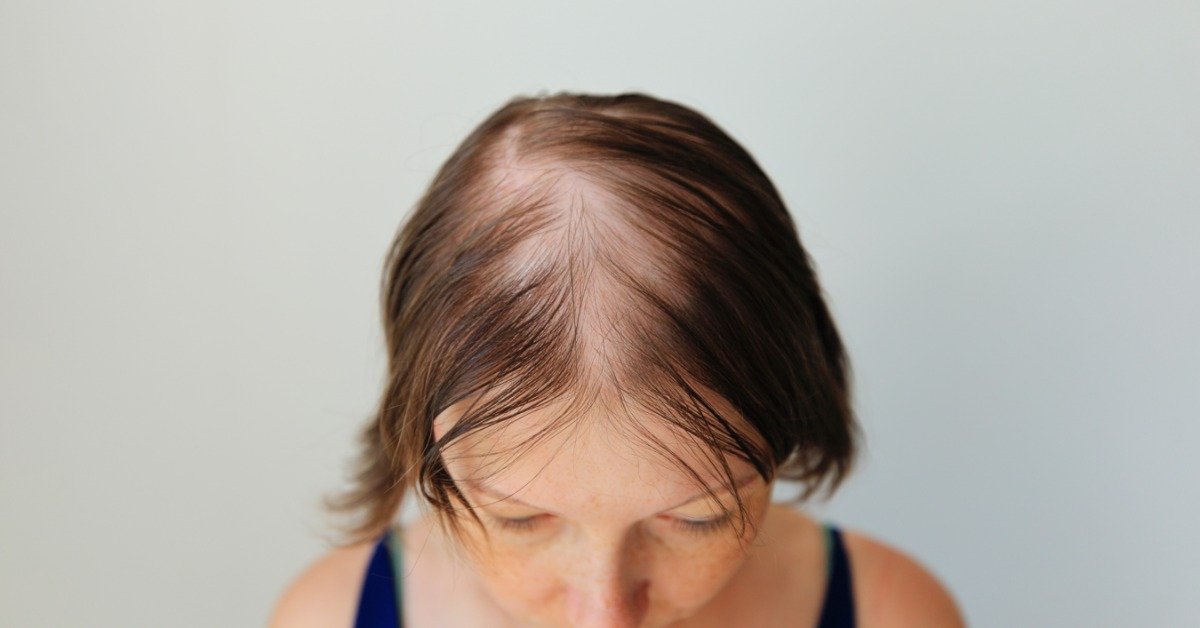 The top of a woman's head showing off a large bald spot on her crown. The hair is thinning all around the spot.