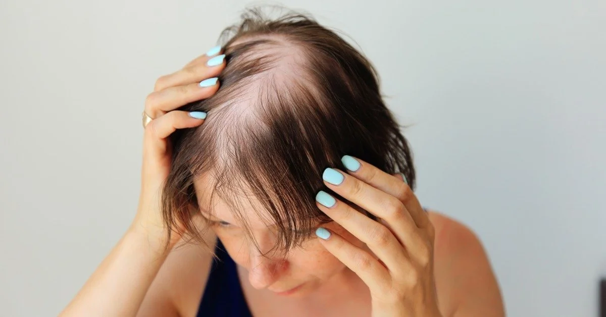 A view of the top of a woman's head. There is noticeable hair loss at her head's crown as she is pulling it to the side.