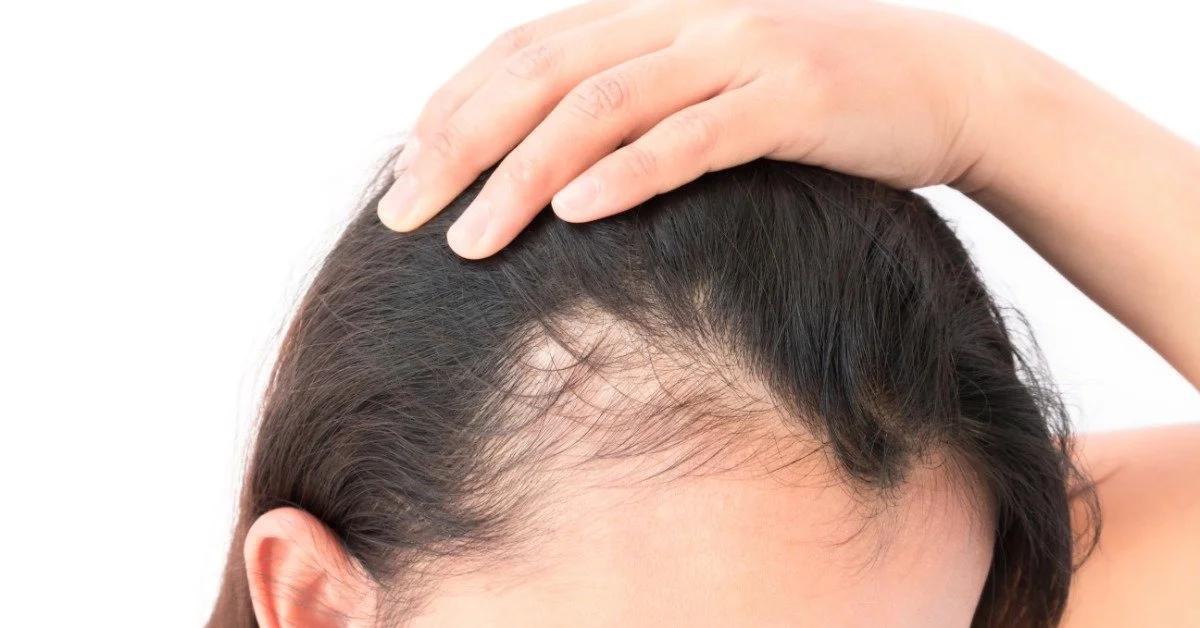 A woman pulling her hairline to one side, exposing the fact that she has lost a lot of hair along the front.