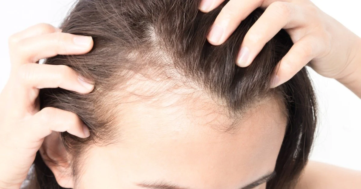 A woman parting her hair to one side to inspect the hair loss that is visible there. She is revealing a receding hairline.