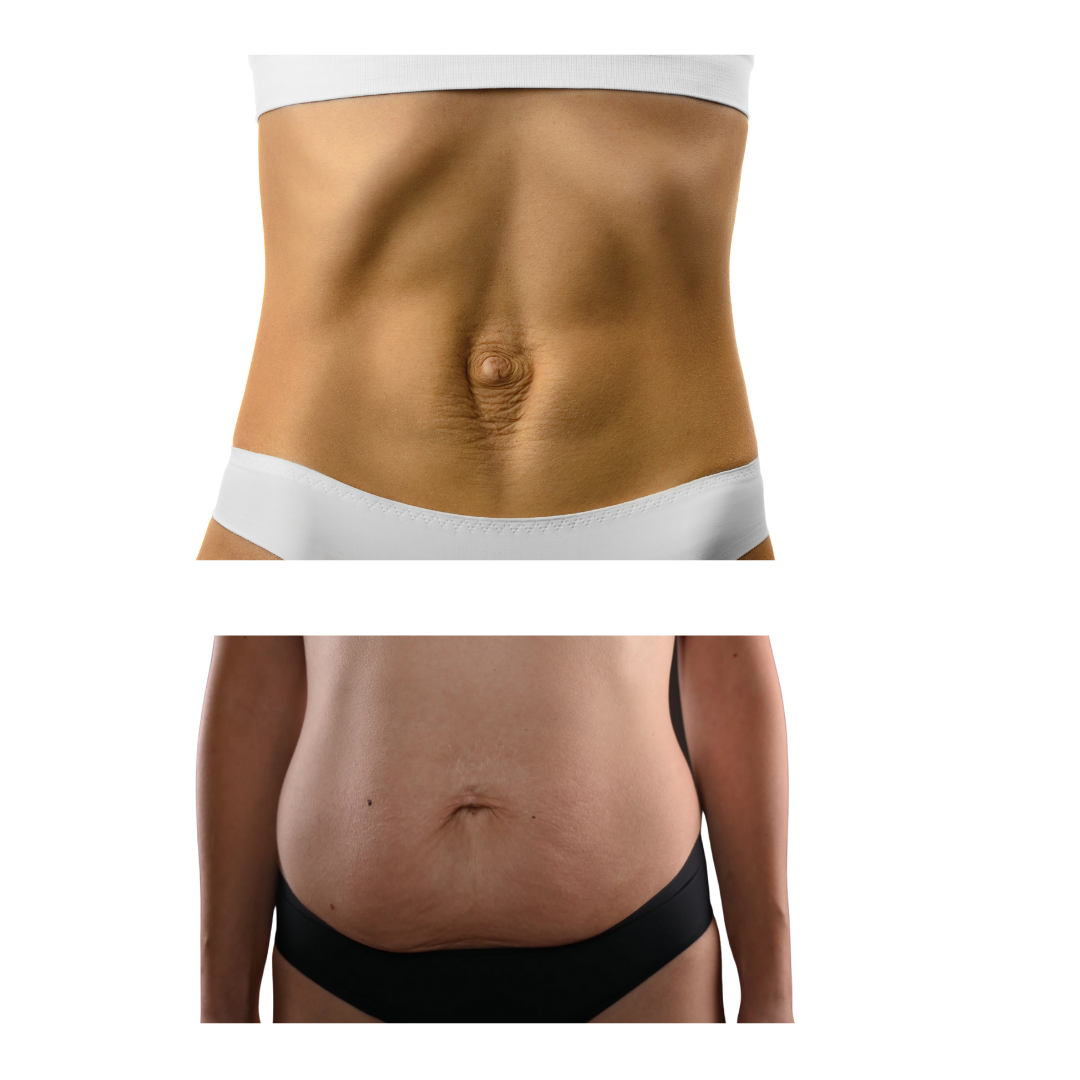 How Physical Therapy Can Help Prevent and Resolve Diastasis Recti