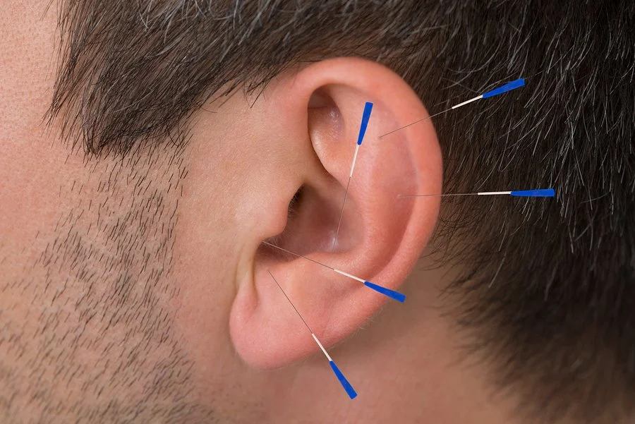 Auricular-Acupuncture.jpg