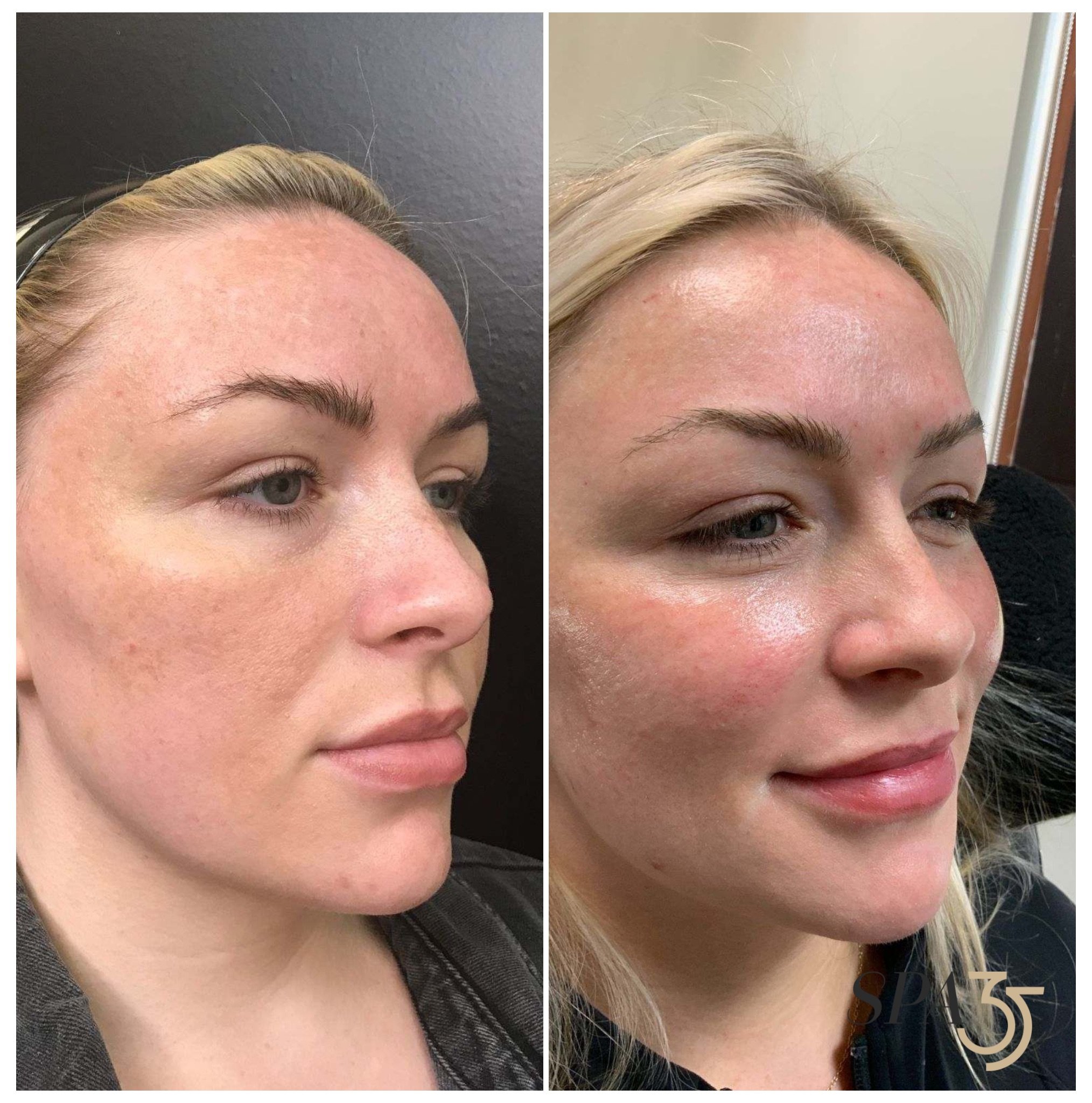 Dermal Filler injections restore lost volume in the mid face and temples