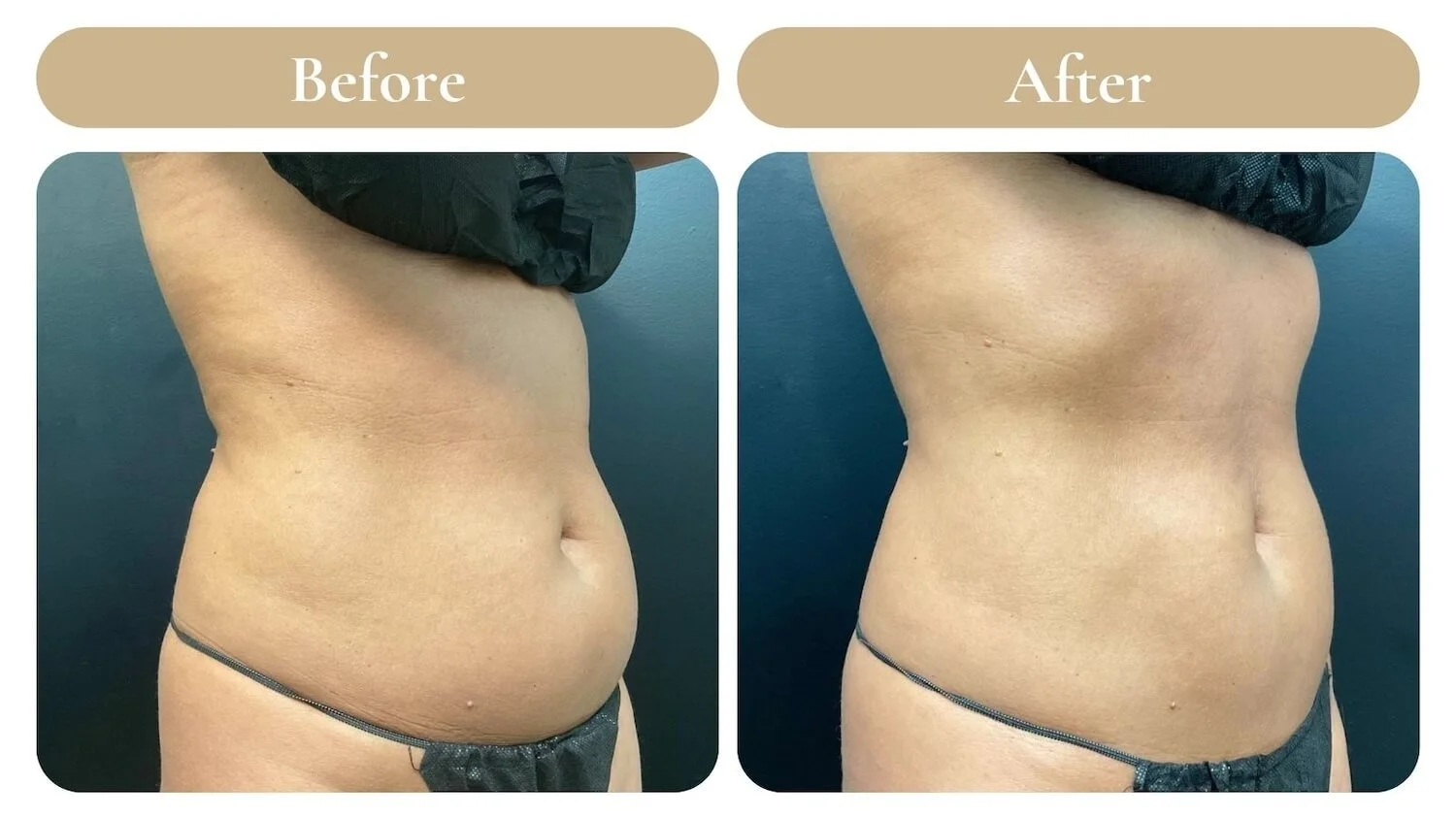 glp 1 weight loss injections boise id CoolSculpting in Boise: Freeze Fat & Sculpt Your Dream Body Without Surgery — Spa 35 I Boise Med Spa