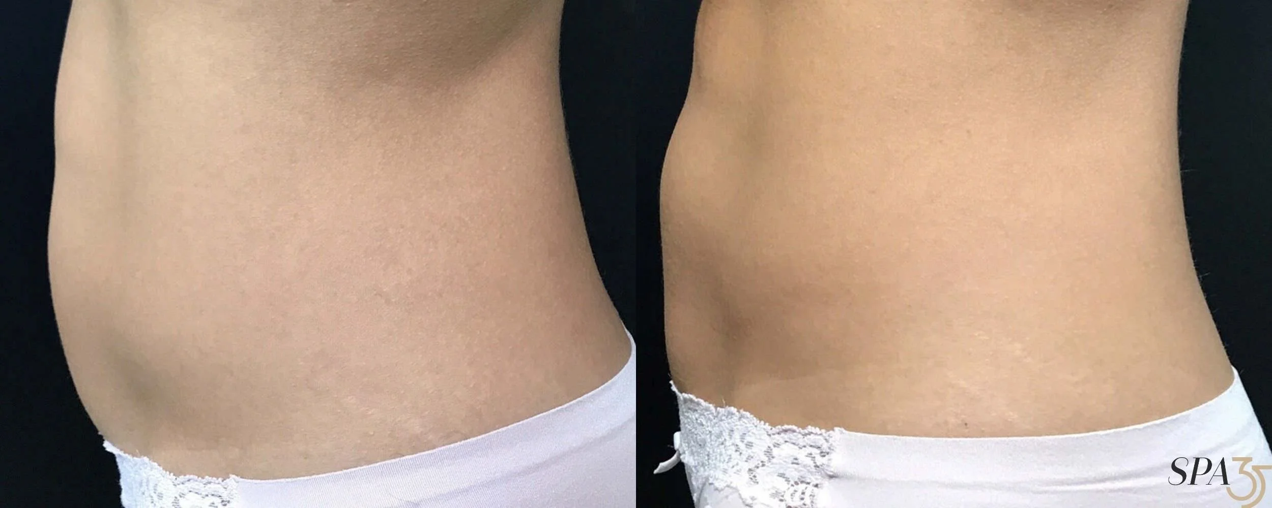 Abdomen-1-side angle.jpg