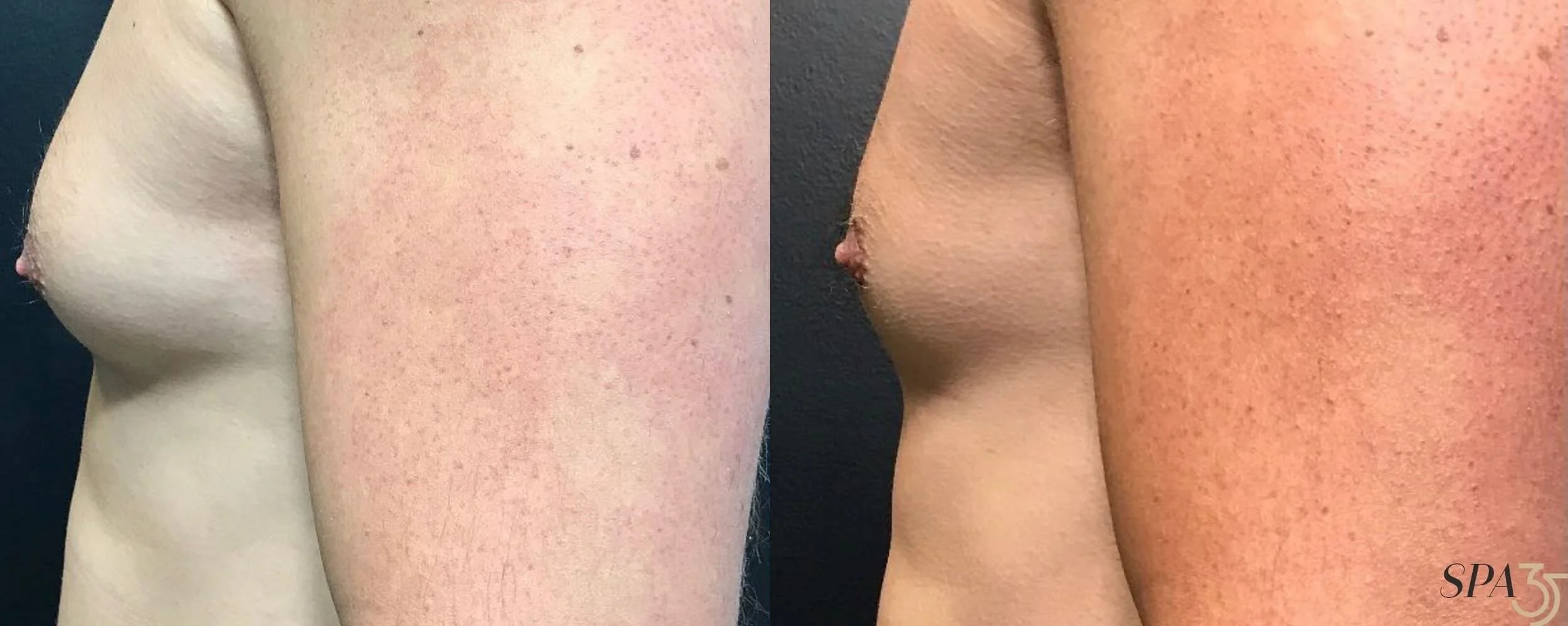 Gynecomastia-1.jpg