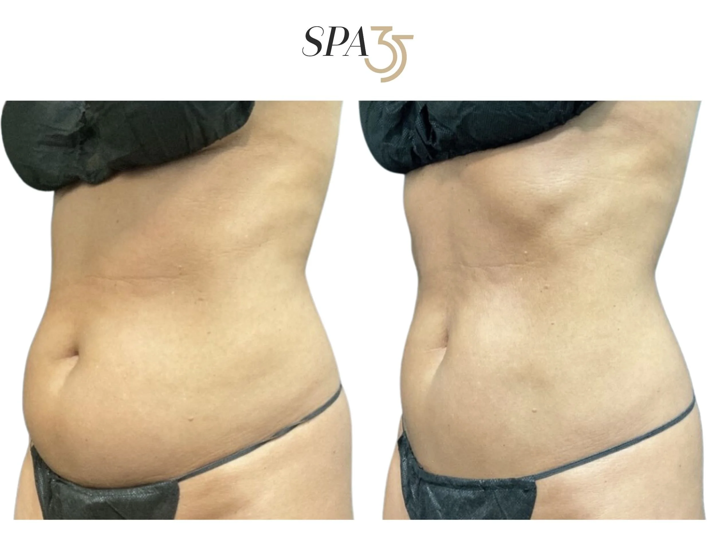 CoolSculpting Fat Removal at Spa 35 Medical Spa