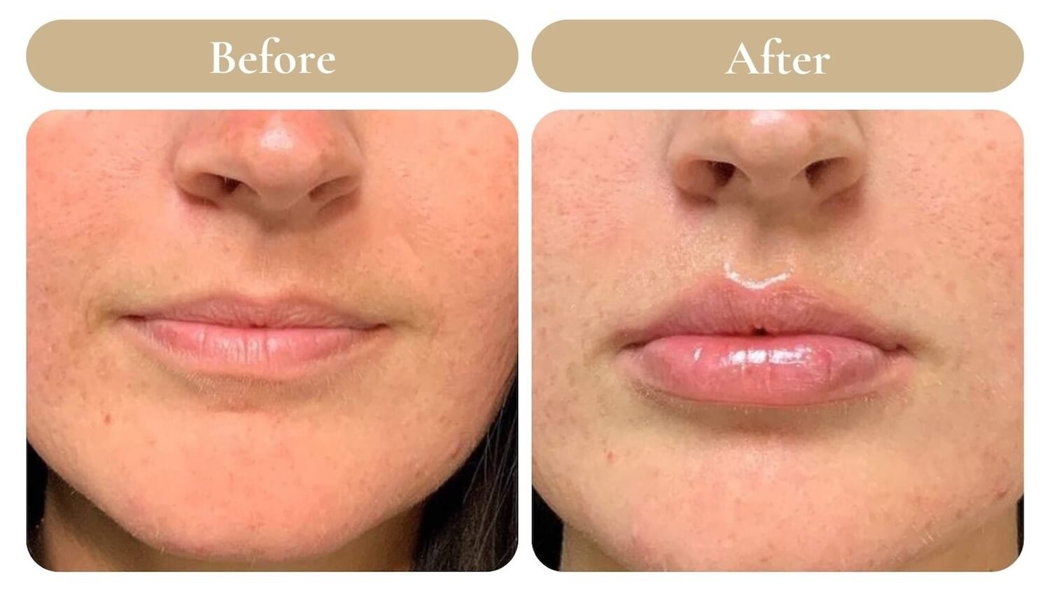Dermal Filler Lip Injections - Kissable Lips for Valentines Day