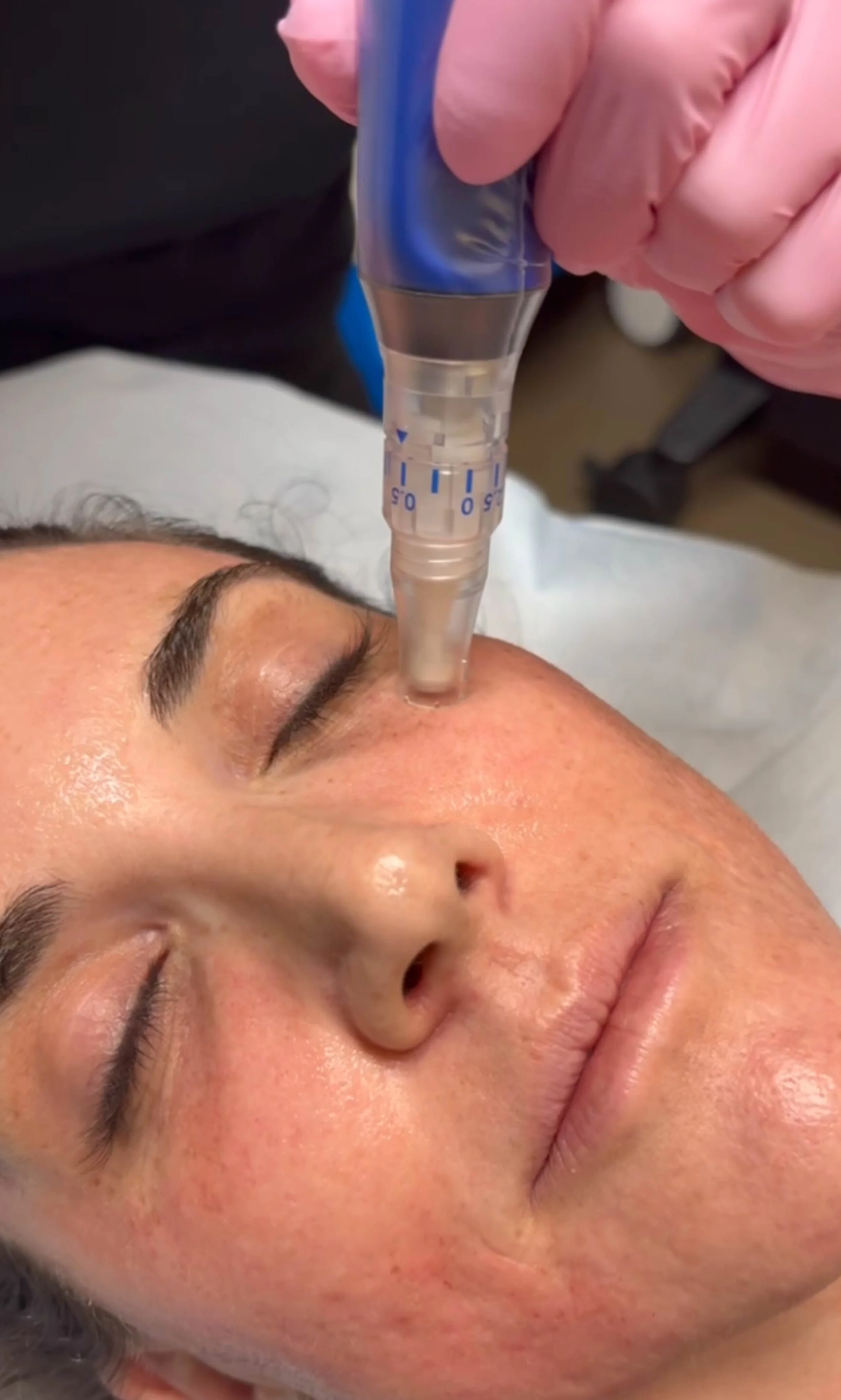 A person receiving a cosmetic treatment with a medical device on their forehead, lying down with eyes closed.