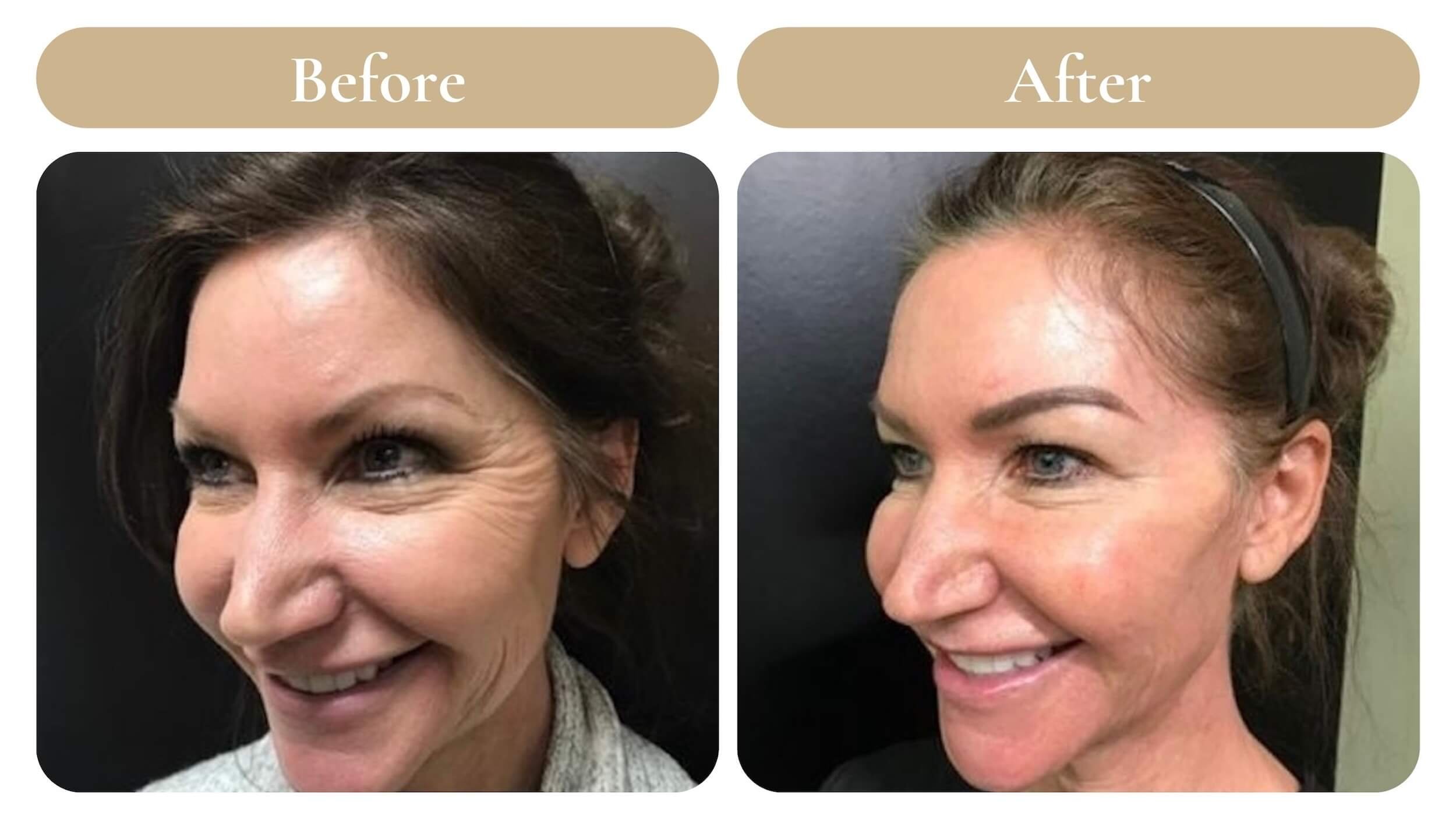 before and after comparison of crows feet on a woman in her 50s
