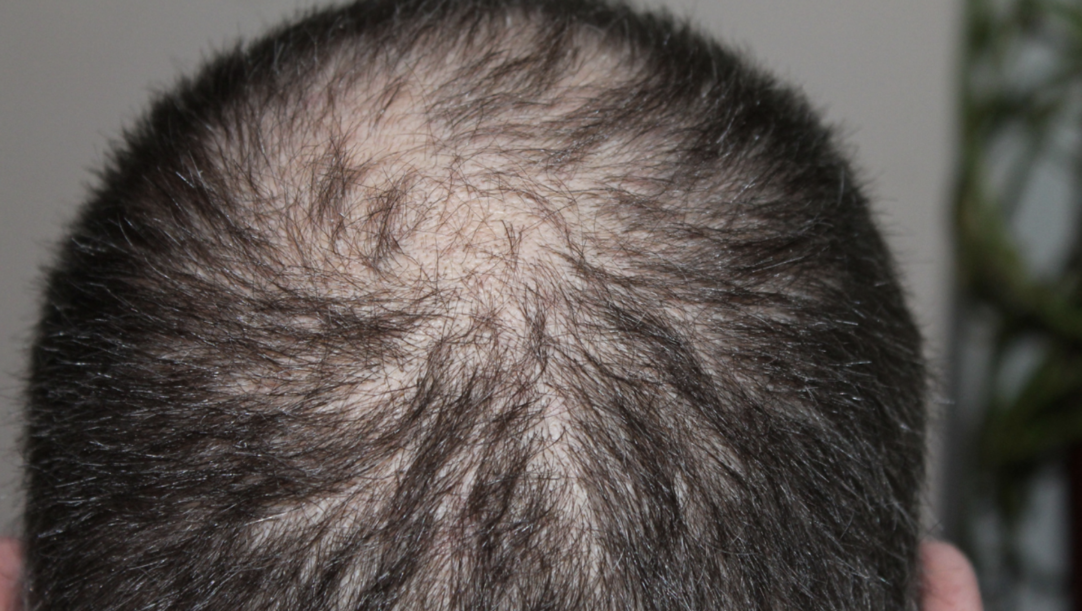 PRP Hair Restoration: A Revolutionary Approach to Hair Regrowth