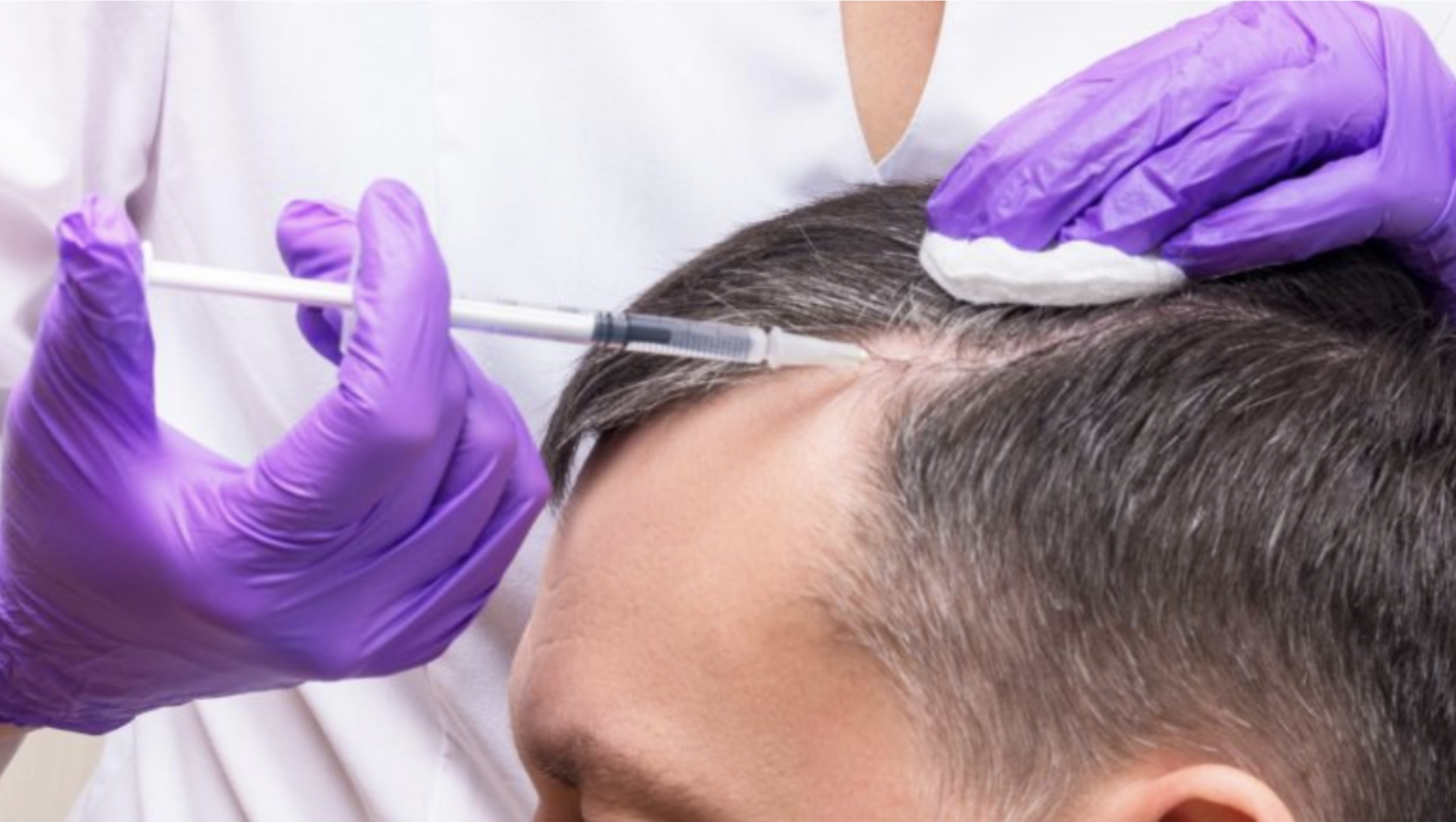 Understanding the Benefits of PRP Hair Restoration for Thinning Hair