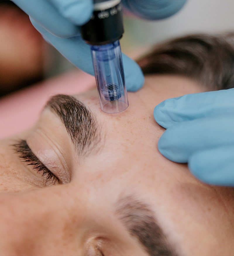 Microneedling with Rejuran Synergy | Glow Salmon DNA Skin Booster