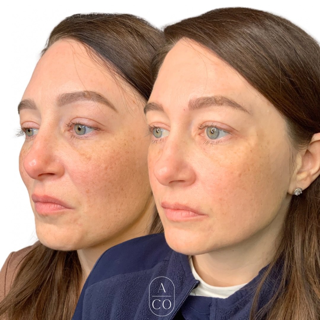 Hyperpigmentation? Pico. Sun spots? Pico. Acne scars? Pico. Anti-Aging? Pico. Texture? Pico. 

Enhanced glow? PICO!!