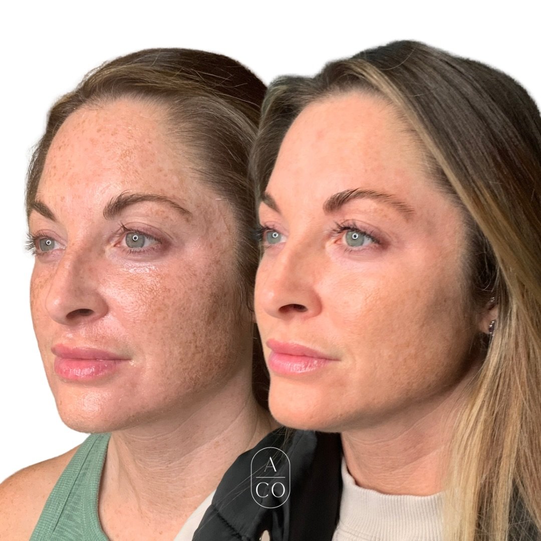 Proof is in the Pico 🙌🏼 

These results come after just ONE pico treatment 👏 we also dissolved lips + this client couldn&rsquo;t be more pleased! 

We have another session on the books for her.. stay tuned for more magic!