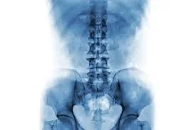 Low Back Pain: When Do You Actually Need Imaging? (X-Ray or MRI)