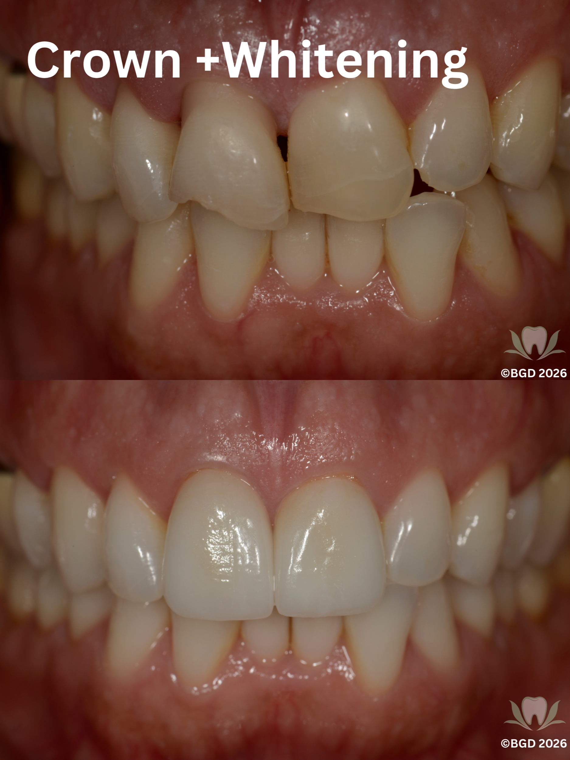 Crown and whitening