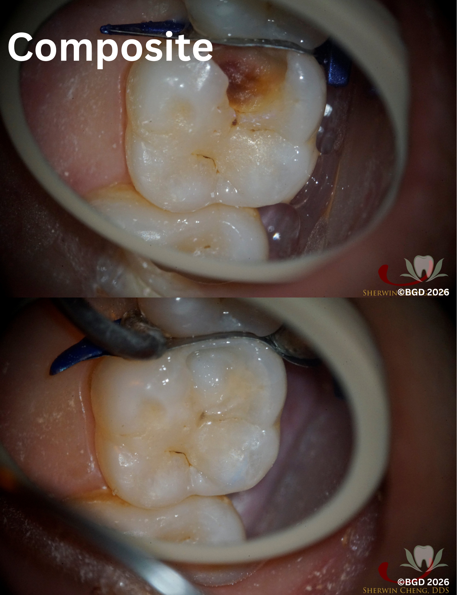 composite filling  restoration