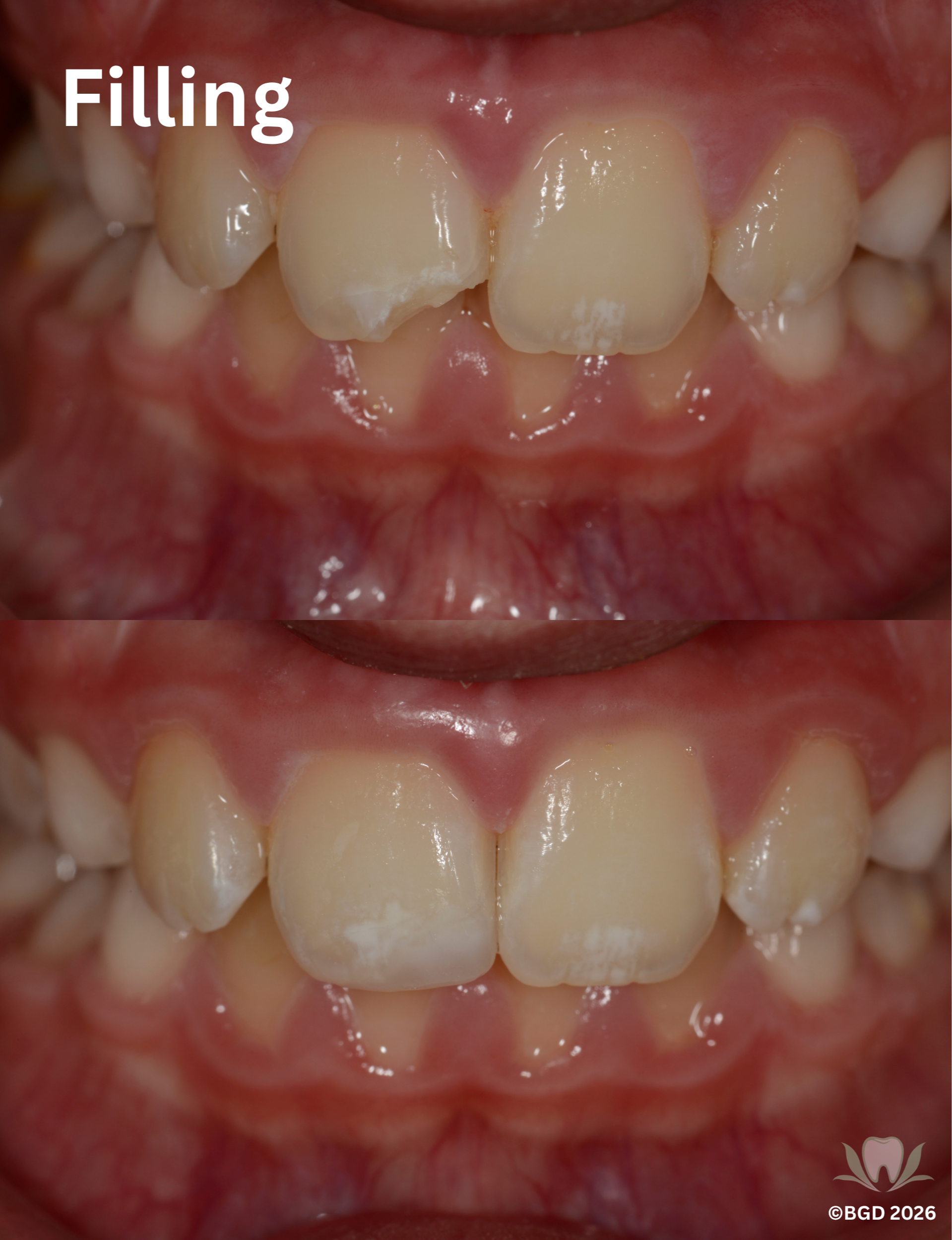 Cosmetic filling