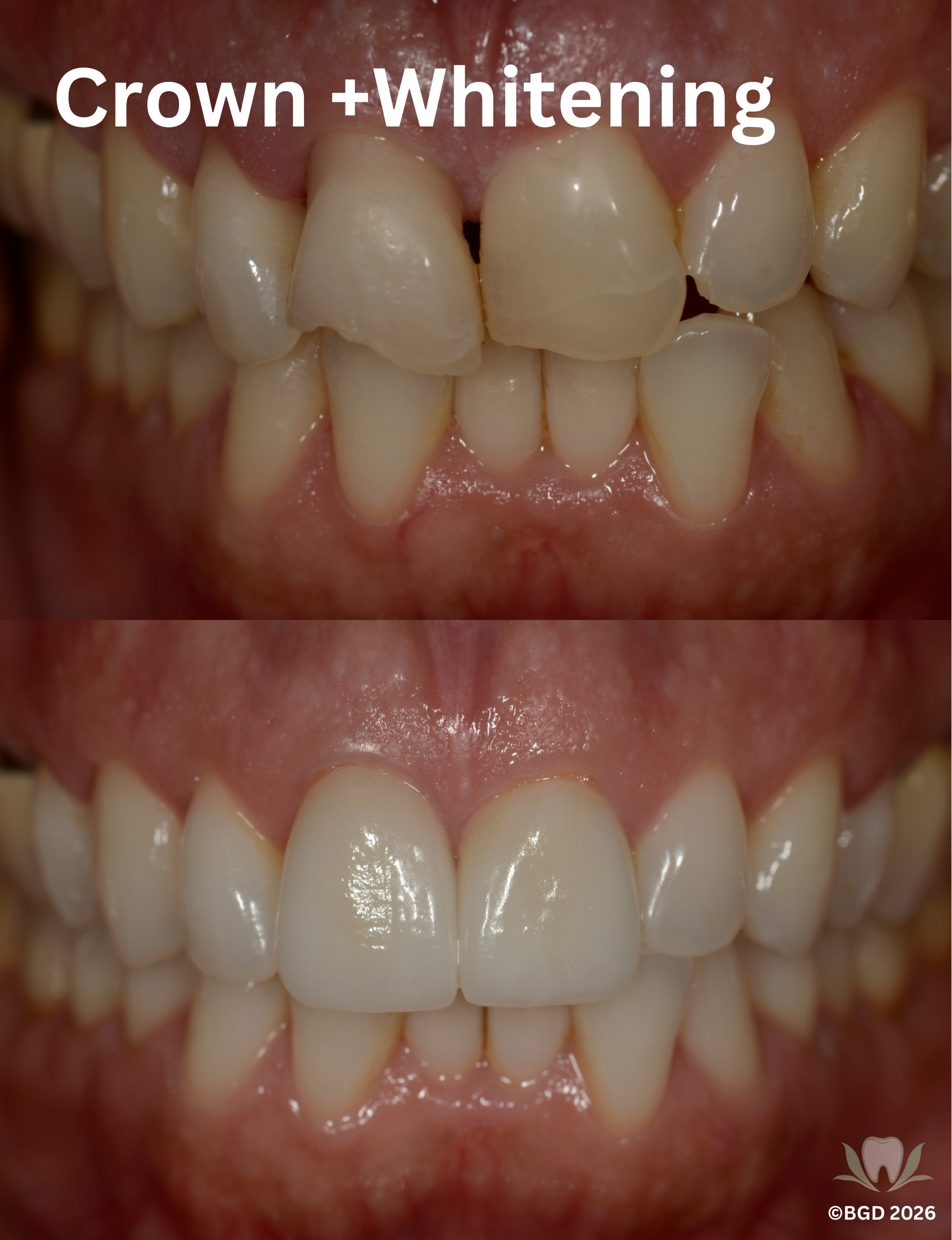 Crown and Whitening 