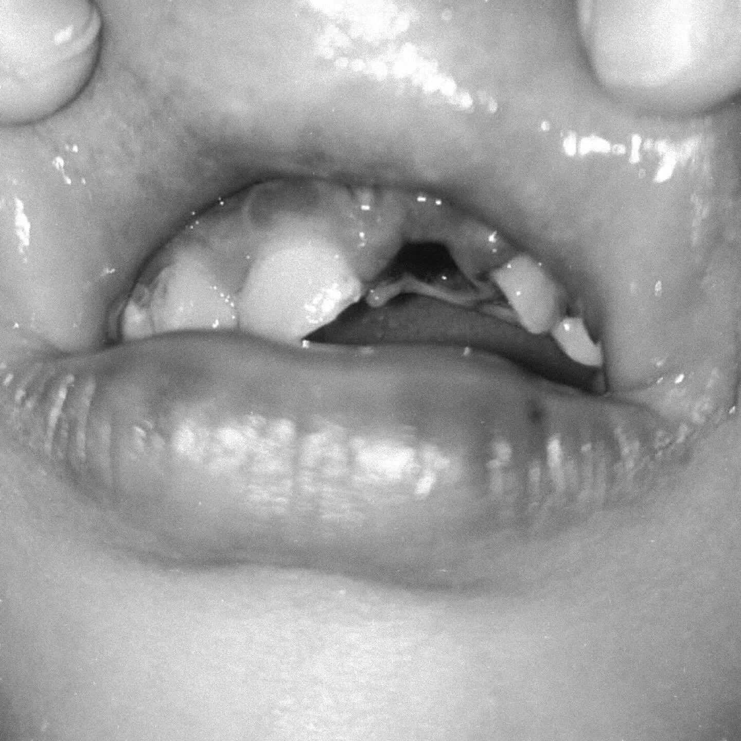 From T&iacute;a Ana&rsquo;s House 🤍

One of the kids from T&iacute;a Ana&rsquo;s House had a serious fall and lost a permanent tooth, and another one was badly chipped. We rushed him to the dentist and they are doing everything possible to try to sa