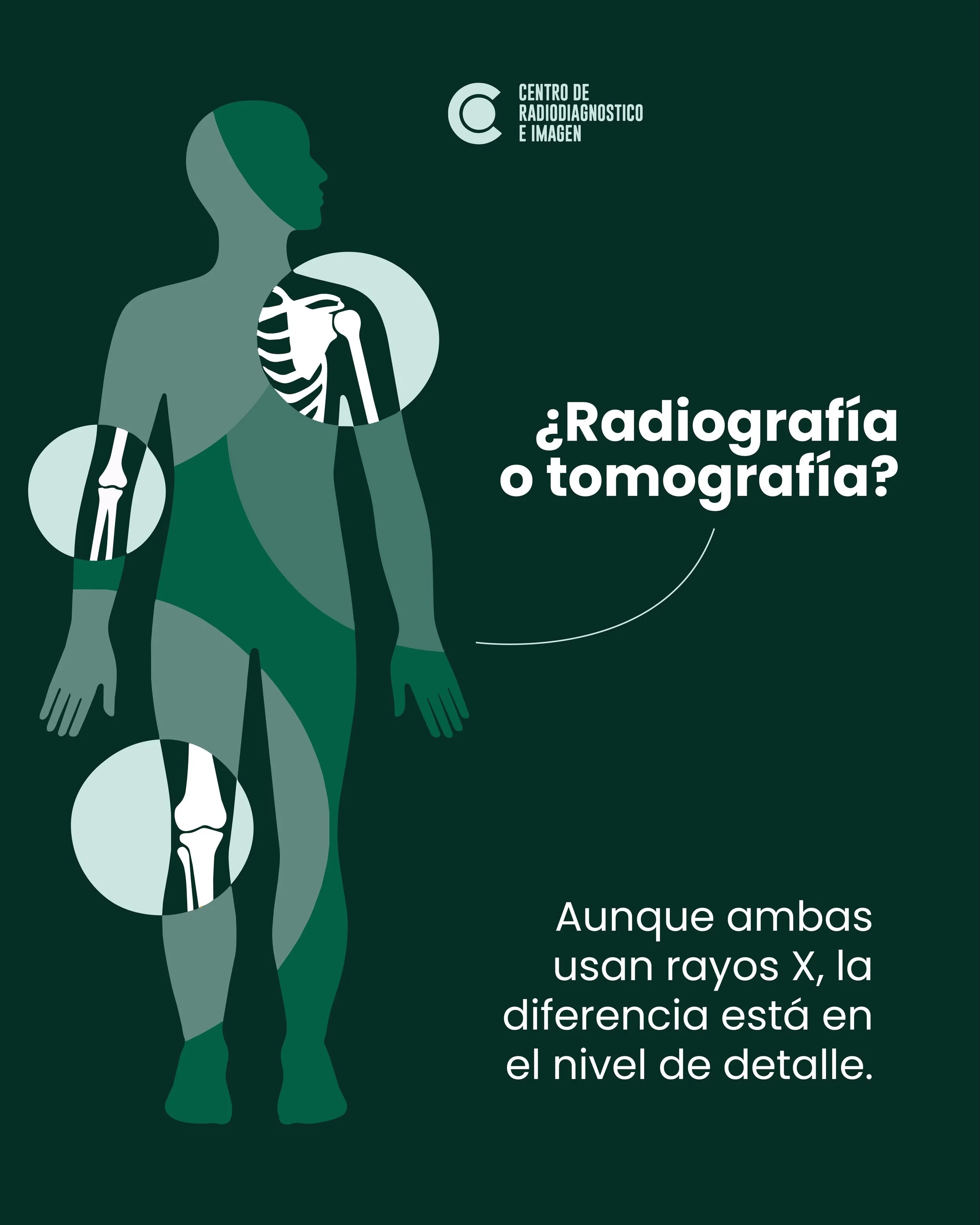 Aunque la radiograf&iacute;a y la tomograf&iacute;a utilizan rayos X, no sirven para lo mismo.

La radiograf&iacute;a permite evaluar principalmente huesos, mientras que la tomograf&iacute;a genera im&aacute;genes mucho m&aacute;s detalladas de &oacu