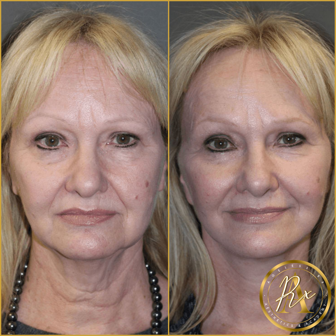 Copy of botox before & after (96).png