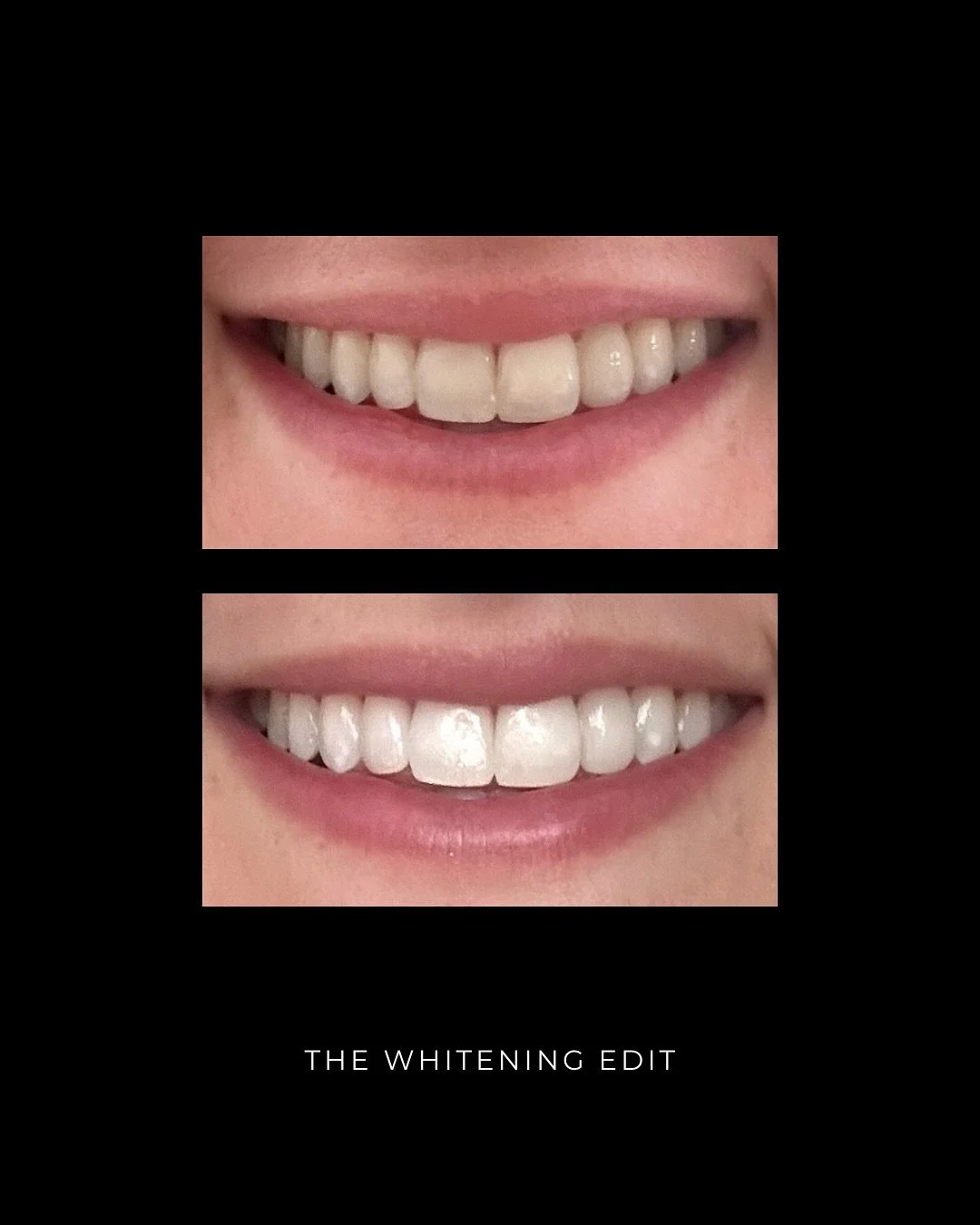 The kind of difference you feel just as much as you see. 

A brighter smile isn&rsquo;t just about looks - it&rsquo;s about feeling confident, put together, and completely yourself.

🔹 Mobile appointments 
🔹 Premium formula 
🔹 Dental hygienist-led