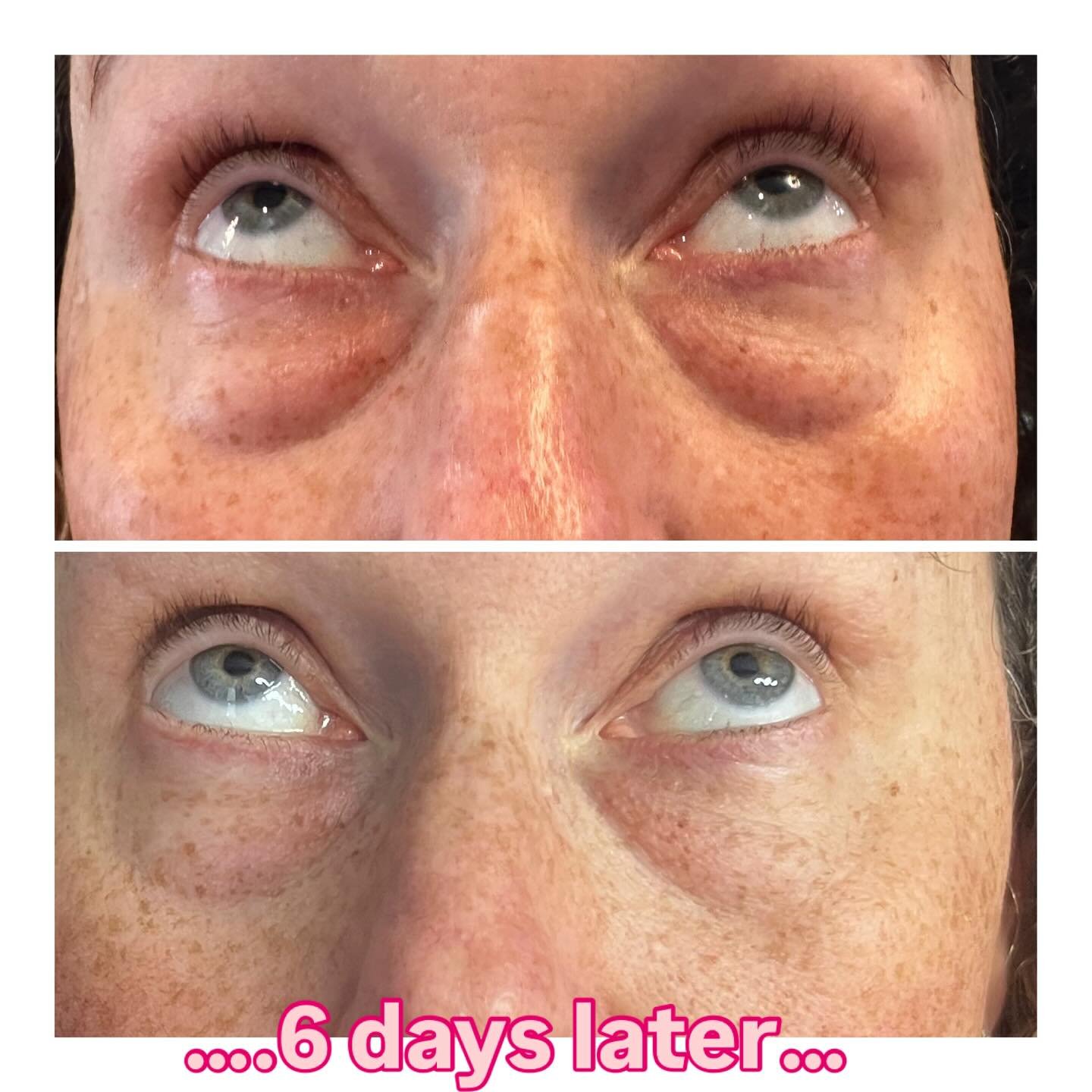 ✨ Everesse Transformation! ✨
Only ONE week apart &mdash; and look at that incredible improvement already 😍
Your skin will continue to tighten, lift, and glow over the next 90 days as collagen rebuilds for your most radiant results yet 💫

Don&rsquo;